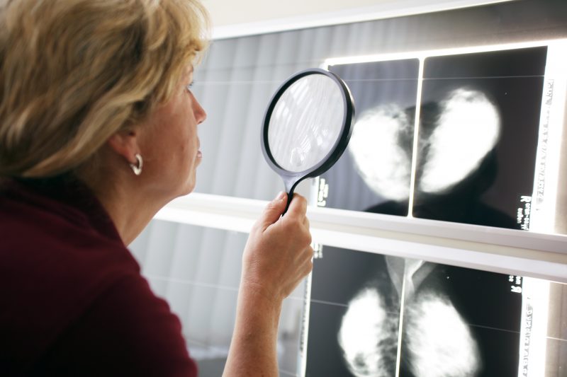 Prévention : faut-il vraiment commencer les mammographies dès 30 ans ?
