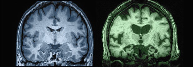 Les bienfaits des oméga-3 sur votre cerveau